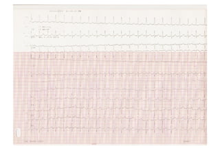 Fibrilación Auricular