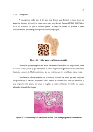 80
5.3.1.1 Osteoporose
A osteoporose nada mais é do que uma doença que diminui a massa óssea do
esqueleto humano, deixando os ossos muito mais suscetíveis à fraturas (TODA BIOLOGIA,
s.d.). Ao contrário do que se costuma pensar, os ossos do corpo são porosos e estão,
constantemente, passando por um processo de recomposição.
Figura 66 – Visão transversal de um osso sadio
Das células que fazem parte dos ossos, têm-se os Osteoblastos (do grego osteon, osso,
e blastos, “célula jovem”), que apresentam extensas projeções citoplasmáticas que permitem a
interação com os osteoblastos vizinhos, e que são responsáveis por constituir a massa óssea.
Quando estas células amadurecem, constituem o Osteócito, sendo que suas projeções
citoplasmáticas se retraem, passando a servir apenas de comunicação entre os osteócitos, e
que originam uma lacuna, por onde o oxigênio e outros nutrientes provindos do sangue
chegarão até as células ósseas.
Figura 67 – Fotomicrografia das células ósseas, com destaque para os Osteoblastos
 