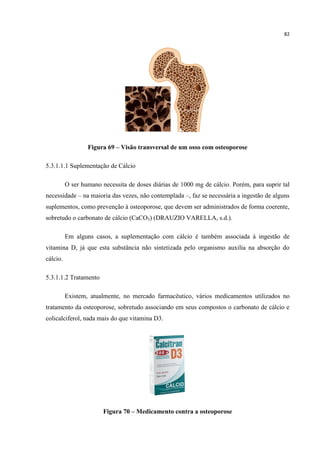 82
Figura 69 – Visão transversal de um osso com osteoporose
5.3.1.1.1 Suplementação de Cálcio
O ser humano necessita de doses diárias de 1000 mg de cálcio. Porém, para suprir tal
necessidade – na maioria das vezes, não contemplada –, faz se necessária a ingestão de alguns
suplementos, como prevenção à osteoporose, que devem ser administrados de forma coerente,
sobretudo o carbonato de cálcio (CaCO3) (DRAUZIO VARELLA, s.d.).
Em alguns casos, a suplementação com cálcio é também associada à ingestão de
vitamina D, já que esta substância não sintetizada pelo organismo auxilia na absorção do
cálcio.
5.3.1.1.2 Tratamento
Existem, atualmente, no mercado farmacêutico, vários medicamentos utilizados no
tratamento da osteoporose, sobretudo associando em seus compostos o carbonato de cálcio e
colicalciferol, nada mais do que vitamina D3.
Figura 70 – Medicamento contra a osteoporose
 