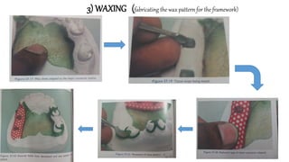 Wax Pattern Rpd fabrication-of-rpd_compress.pdf dentistry | PDF