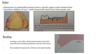 Beading Rpd fabrication-of-rpd_compress.pdf dentistry | PDF