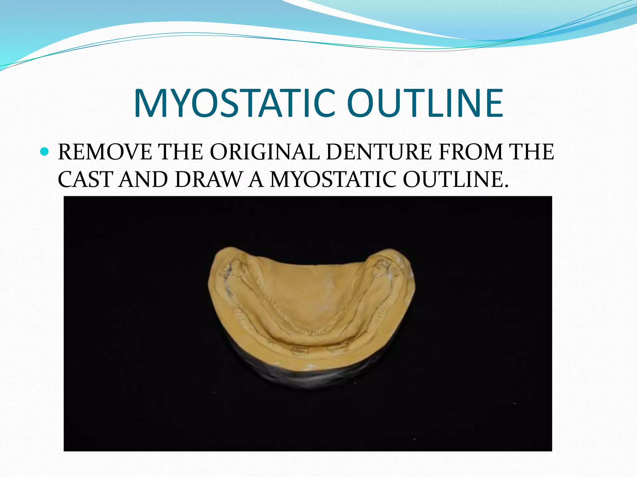 MYOSTATIC OUTLINE
 REMOVE THE ORIGINAL DENTURE FROM THE
CAST AND DRAW A MYOSTATIC OUTLINE.
 