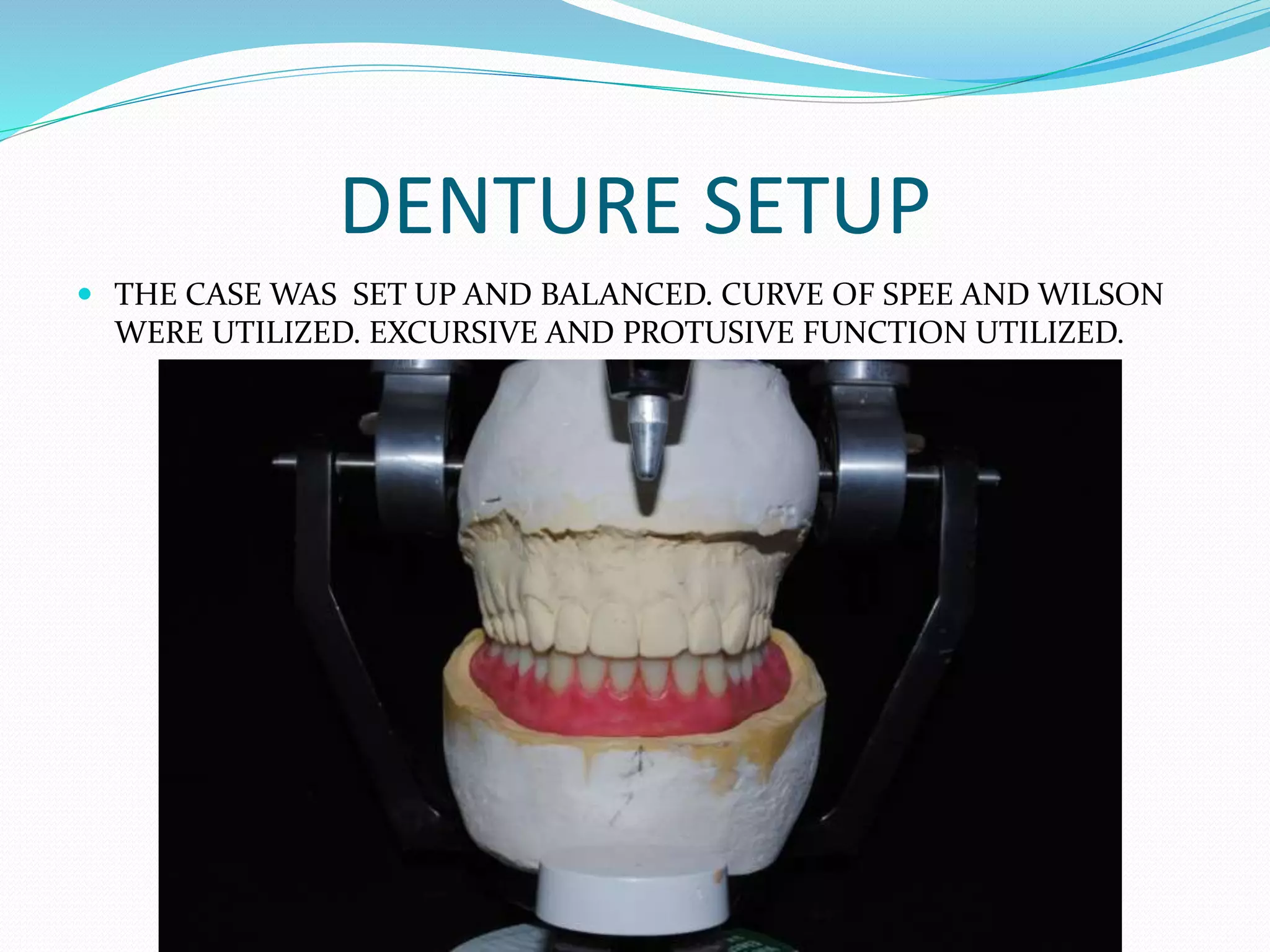 DENTURE SETUP
 THE CASE WAS SET UP AND BALANCED. CURVE OF SPEE AND WILSON
WERE UTILIZED. EXCURSIVE AND PROTUSIVE FUNCTION UTILIZED.
 