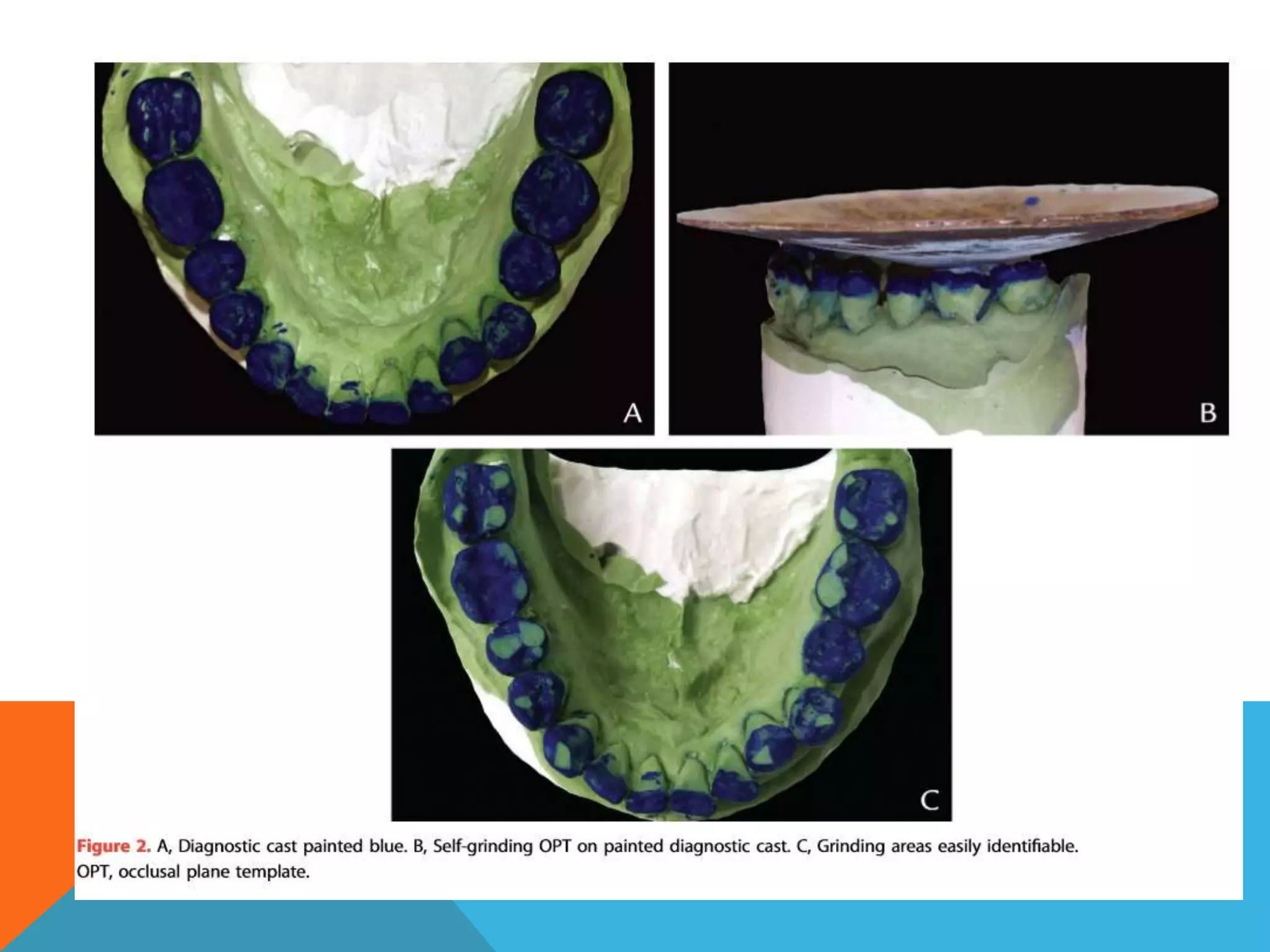Fabrication of self grinding occlusal plane template | PPTX