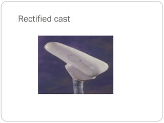 Radial Socket Spring FABRICATION OF prosthetic TRANS RADIAL SOCKET.pdf