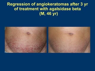 Regression of angiokeratomas after 3 yr
   of treatment with agalsidase beta
                (M, 46 yr)
 