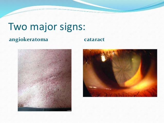 the diagnosis and treatment for the fabry disease What is fabry disease symptoms, causes, diagnosis and treatment fabry disease is caused by the deficiency of the lysosomal enzyme alpha-galactosidase a as. the diagnosis and treatment for the fabry disease What is fabry disease symptoms, causes, diagnosis and treatment fabry disease is caused by the deficiency of the lysosomal enzyme alpha-galactosidase a as.