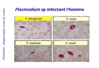 Paludisme:diagnostiqueravantdetraiter
Plasmodium sp infectant l’homme
P. falciparum
P. malariae P. ovale
P. vivax
 