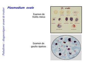 Paludisme:diagnostiqueravantdetraiter
Plasmodium ovale
Examen de
frottis mince
Examen de
goutte épaisse
 