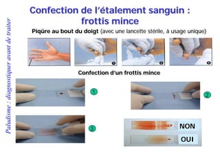 Paludisme:diagnostiqueravantdetraiter Confection de l’étalement sanguin :
frottis mince
Piqûre au bout du doigt (avec une lancette stérile, à usage unique)
Confection d’un frottis mince
OUI
NON
1
2
3
 