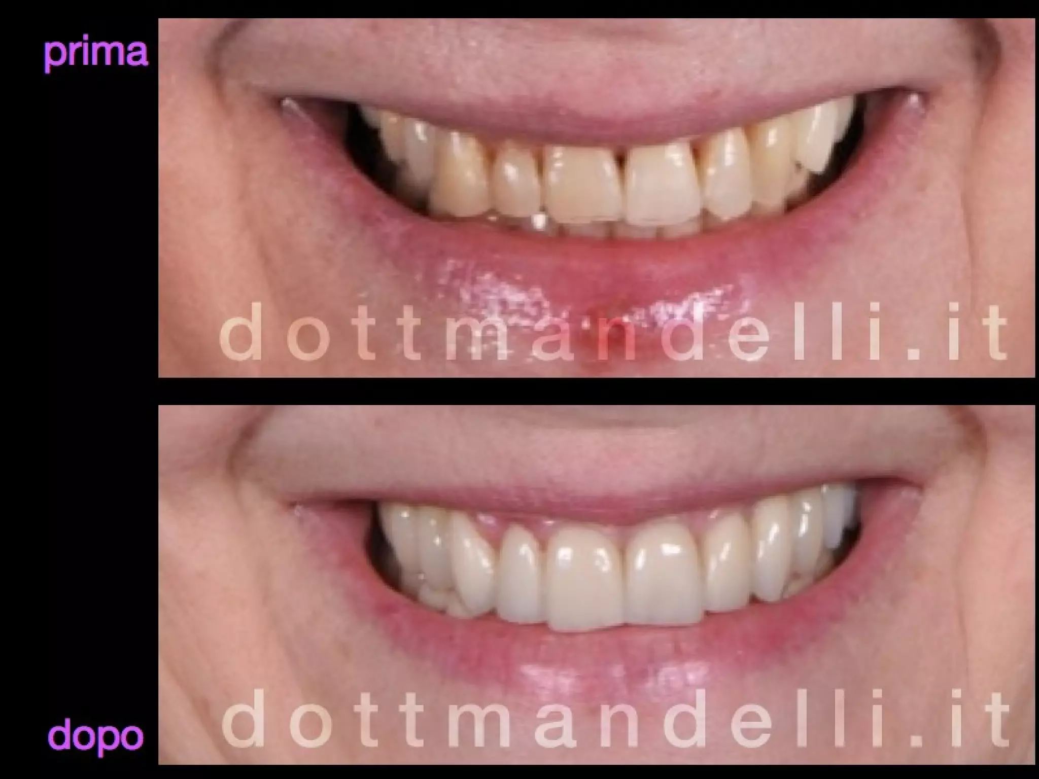 Faccette dentali estetica del sorriso PPT