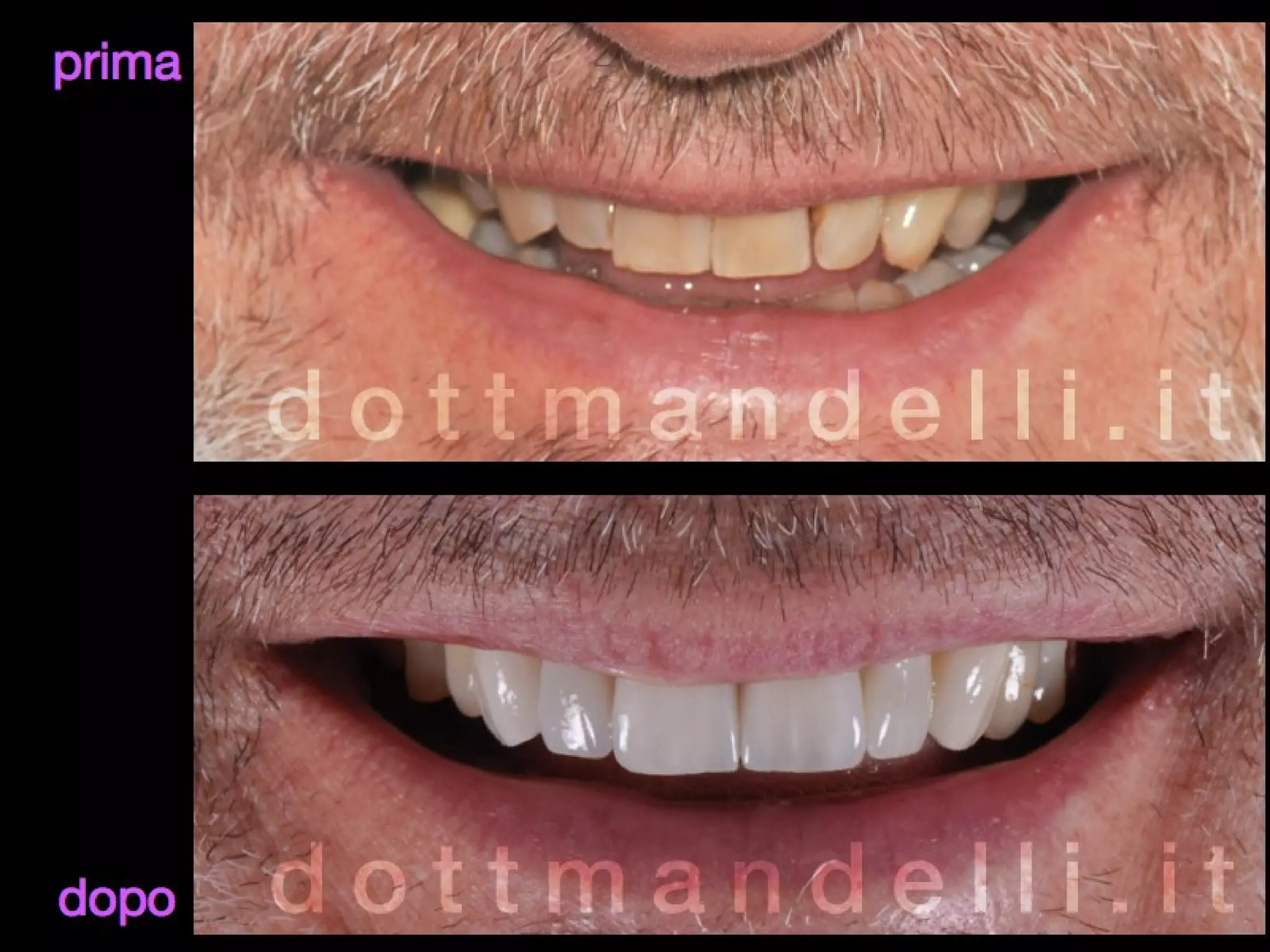 Kit Per Resina Dentale: Stampo, Spatola E Luce Per Cura - Ideale Per