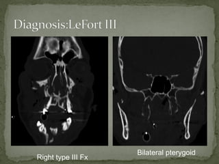 Right type III Fx
Bilateral pterygoid