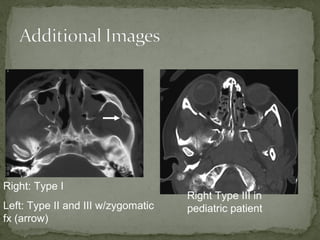 Right: Type I
Left: Type II and III w/zygomatic
fx (arrow)
Right Type III in
pediatric patient