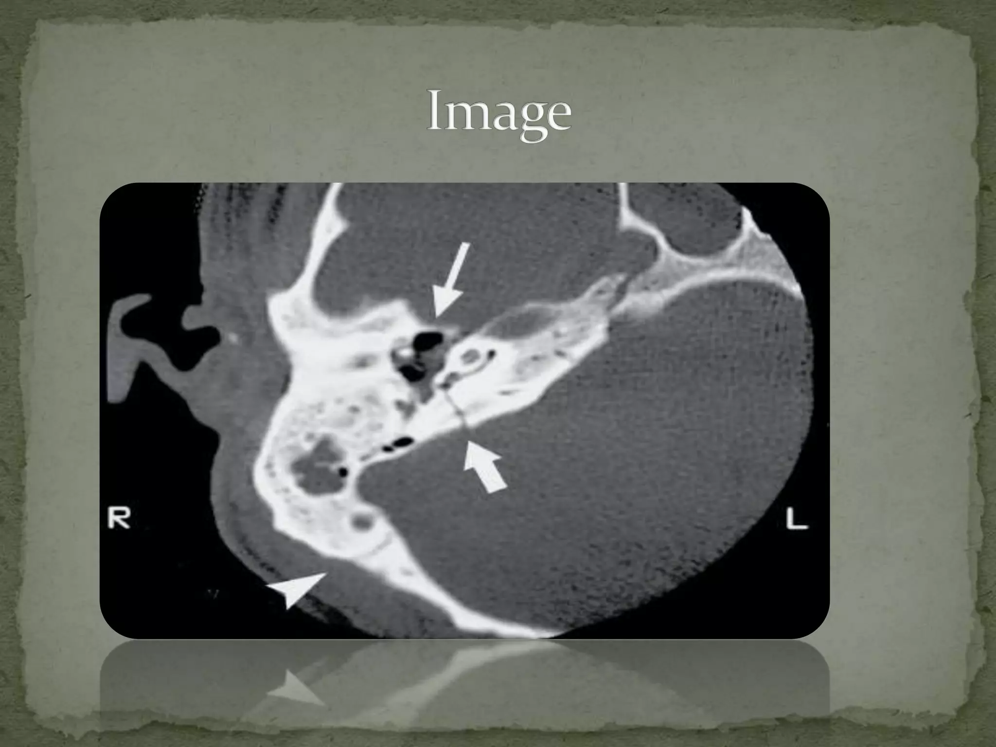 Basilar Skull Fracture PPT