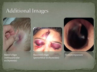 Battle’s Sign
(retroauricular
ecchymosis)

Raccoon’s Sign
(periorbital ecchymoses)

Hemotympanum

 