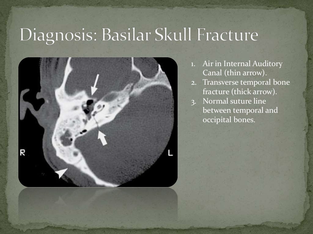 Basilar Skull Fracture