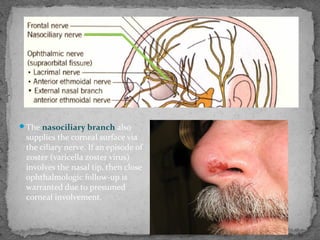 The nasociliary branch also
supplies the corneal surface via
the ciliary nerve. If an episode of
zoster (varicella zoster virus)
involves the nasal tip, then close
ophthalmologic follow-up is
warranted due to presumed
corneal involvement.
 
