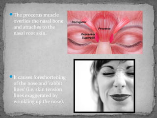 The procerus muscle
overlies the nasal bone
and attaches to the
nasal root skin.
It causes foreshortening
of the nose and 'rabbit
lines‘ (i.e. skin tension
lines exaggerated by
wrinkling up the nose).
 