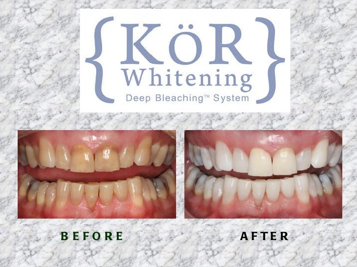 KoR Teeth Whitening Program