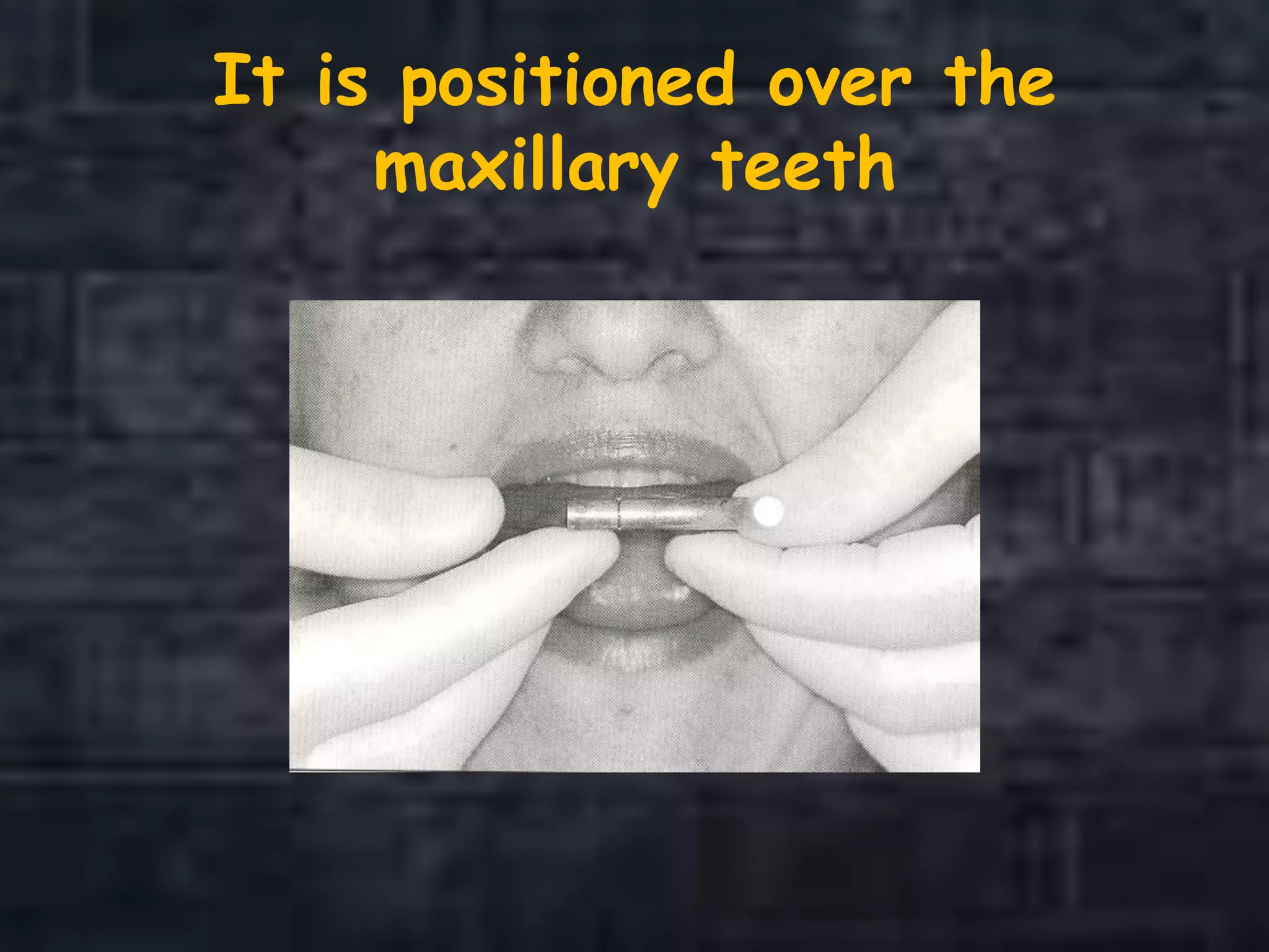 It is positioned over the
maxillary teeth
 