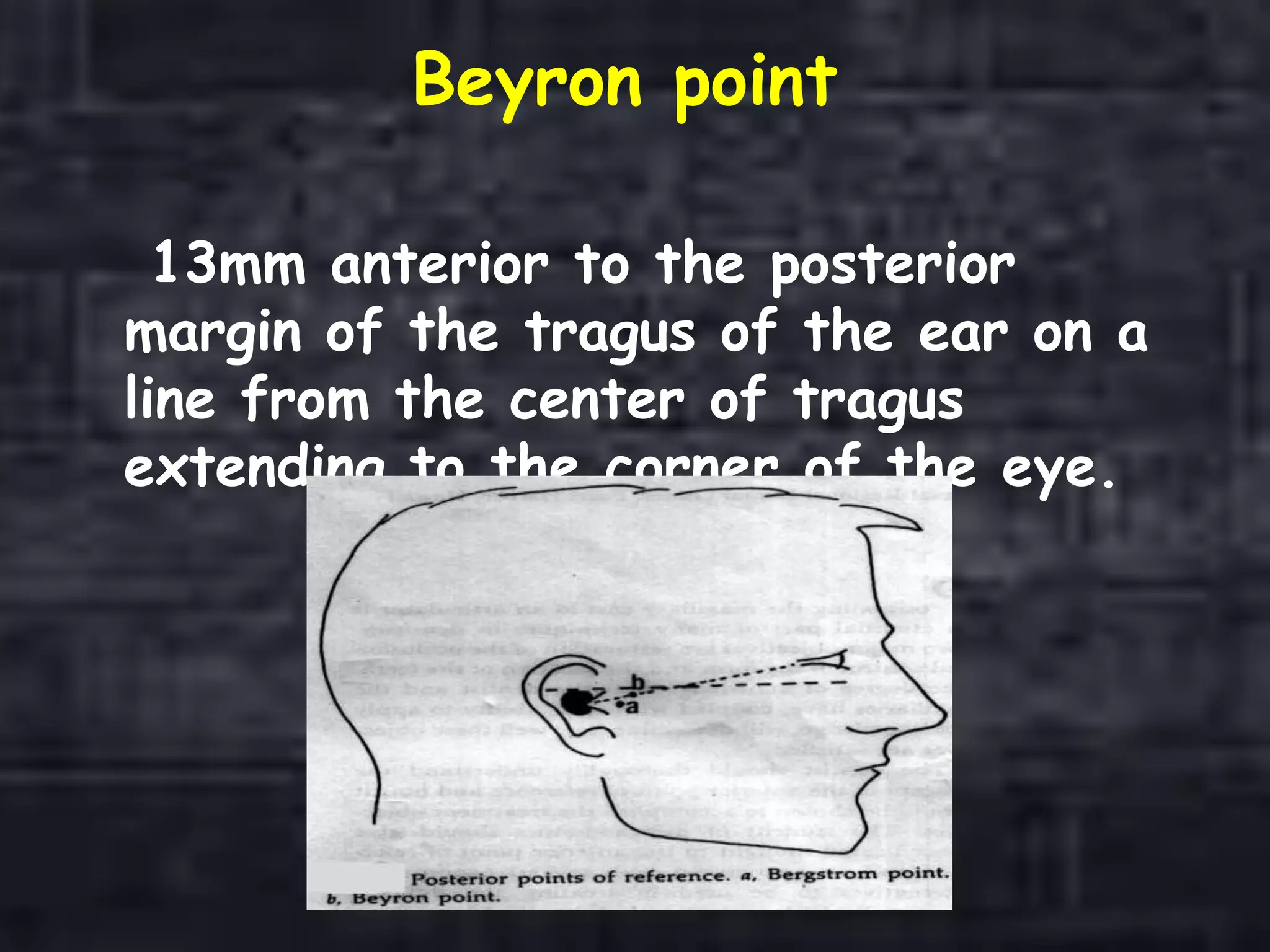 Beyron point
13mm anterior to the posterior
margin of the tragus of the ear on a
line from the center of tragus
extending to the corner of the eye.
 