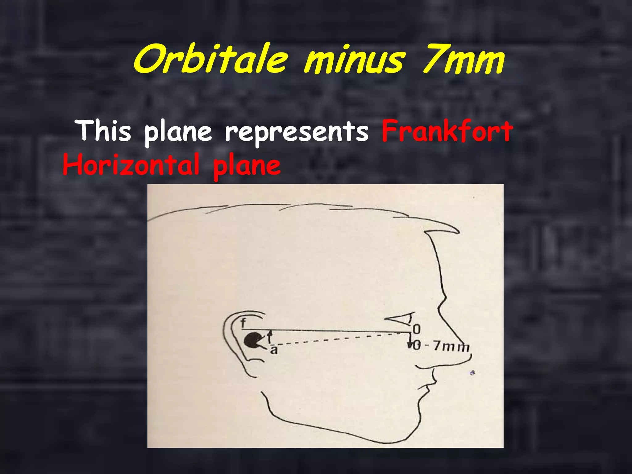 Orbitale minus 7mm
This plane represents Frankfort
Horizontal plane
 