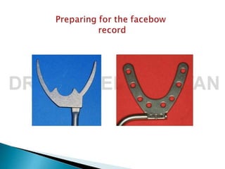 Facebow