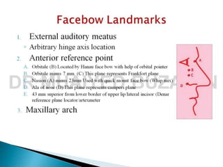 Facebow