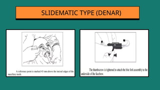 SLIDEMATIC TYPE (DENAR)
 
