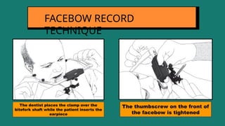 FACEBOW RECORD
TECHNIQUE
The dentist places the clamp over the
bitefork shaft while the patient inserts the
earpiece
The thumbscrew on the front of
the facebow is tightened
 
