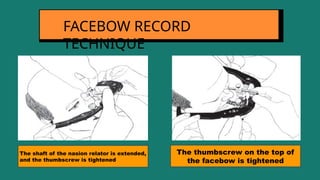 FACEBOW RECORD
TECHNIQUE
The shaft of the nasion relator is extended,
and the thumbscrew is tightened
The thumbscrew on the top of
the facebow is tightened
 