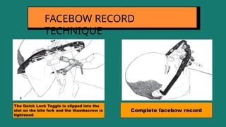 FACEBOW RECORD
TECHNIQUE
The Quick Lock Toggle is slipped into the
slot on the bite fork and the thumbscrew is
tightened
Complete facebow record
 