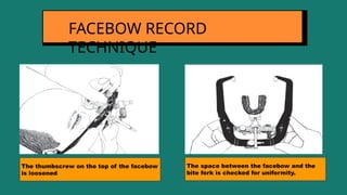 FACEBOW RECORD
TECHNIQUE
The thumbscrew on the top of the facebow
is loosened
The space between the facebow and the
bite fork is checked for uniformity.
 