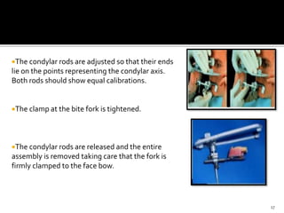 Condylar Rods Facebow part ii | PPTX