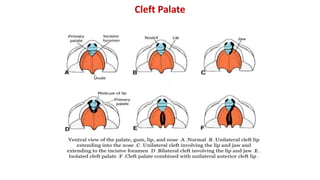Cleft Palate
 