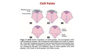 Cleft Palate
 