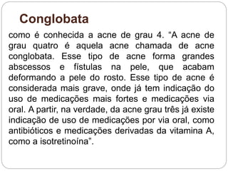 Conglobata
como é conhecida a acne de grau 4. “A acne de
grau quatro é aquela acne chamada de acne
conglobata. Esse tipo de acne forma grandes
abscessos e fístulas na pele, que acabam
deformando a pele do rosto. Esse tipo de acne é
considerada mais grave, onde já tem indicação do
uso de medicações mais fortes e medicações via
oral. A partir, na verdade, da acne grau três já existe
indicação de uso de medicações por via oral, como
antibióticos e medicações derivadas da vitamina A,
como a isotretinoína”.
 