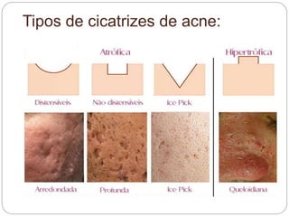 Tipos de cicatrizes de acne:
 
