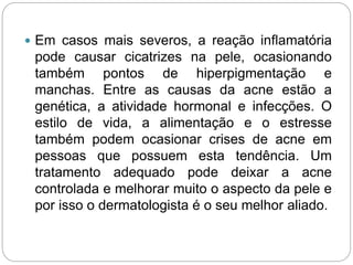  Em casos mais severos, a reação inflamatória
pode causar cicatrizes na pele, ocasionando
também pontos de hiperpigmentação e
manchas. Entre as causas da acne estão a
genética, a atividade hormonal e infecções. O
estilo de vida, a alimentação e o estresse
também podem ocasionar crises de acne em
pessoas que possuem esta tendência. Um
tratamento adequado pode deixar a acne
controlada e melhorar muito o aspecto da pele e
por isso o dermatologista é o seu melhor aliado.
 