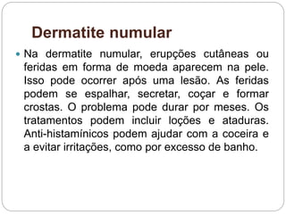 Dermatite numular
 Na dermatite numular, erupções cutâneas ou
feridas em forma de moeda aparecem na pele.
Isso pode ocorrer após uma lesão. As feridas
podem se espalhar, secretar, coçar e formar
crostas. O problema pode durar por meses. Os
tratamentos podem incluir loções e ataduras.
Anti-histamínicos podem ajudar com a coceira e
a evitar irritações, como por excesso de banho.
 