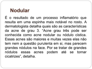 Nodular
É o resultado de um processo inflamatório que
resulta em uma espinha mais notável no rosto. A
dermatologista detalha quais são as características
da acne de grau 3. “Acne grau três pode ser
conhecida como acne nodular ou nódulo cística.
Essas acnes são maiores e muitas vezes elas não
tem nem a questão purulenta em si, mas parecem
grandes nódulos na face. Por se tratar de grandes
nódulos essas acnes podem até se tornar
cicatrizes”, detalha.
 