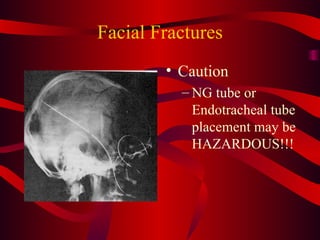 Facial Fractures Caution NG tube or Endotracheal tube placement may be HAZARDOUS!!! 
