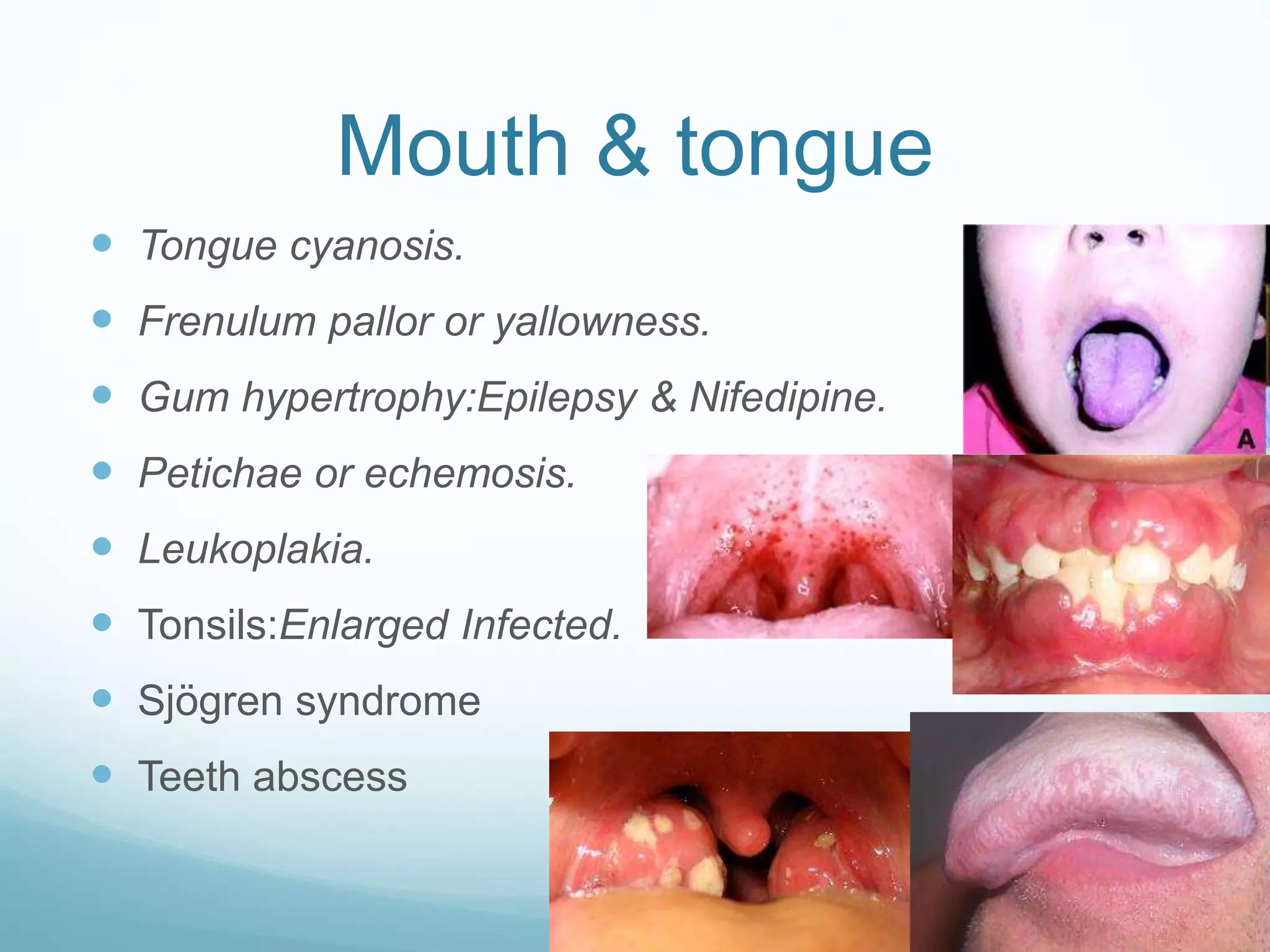 Mouth & tongue
Tongue cyanosis.
Frenulum pallor or yallowness.
Gum hypertrophy:Epilepsy & Nifedipine.
Petichae or echemosis.
Leukoplakia.
Tonsils:Enlarged Infected.
Sjögren syndrome
Teeth abscess