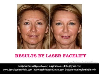 RESULTS BY LASER FACELIFT
www.facialaestheticsdelhi.com
 