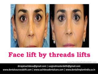 Face lift by threads lifts
www.facialaestheticsdelhi.com
 