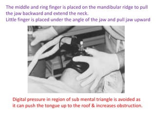 The middle and ring finger is placed on the mandibular ridge to pull
the jaw backward and extend the neck.
Little finger is placed under the angle of the jaw and pull jaw upward
Digital pressure in region of sub mental triangle is avoided as
it can push the tongue up to the roof & increases obstruction.
 