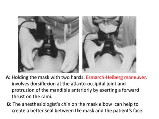 A: Holding the mask with two hands. Esmarch-Heiberg maneuver,
involves dorsiflexion at the atlanto-occipital joint and
protrusion of the mandible anteriorly by exerting a forward
thrust on the rami.
B: The anesthesiologist's chin on the mask elbow can help to
create a better seal between the mask and the patient's face.
 