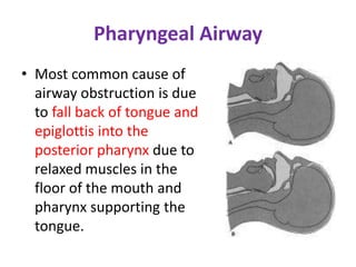 Pharyngeal Airway
• Most common cause of
airway obstruction is due
to fall back of tongue and
epiglottis into the
posterior pharynx due to
relaxed muscles in the
floor of the mouth and
pharynx supporting the
tongue.
 