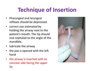 Technique of Insertion
• Pharyngeal and laryngeal
reflexes should be depressed.
• correct size estimated by
holding the airway next to the
patient's mouth. The tip should
rest cephalad to the angle of the
mandible.
• lubricate the airway
• the jaw is opened with the left
hand
• the airway is inserted with its
concave side facing the upper
lip
 